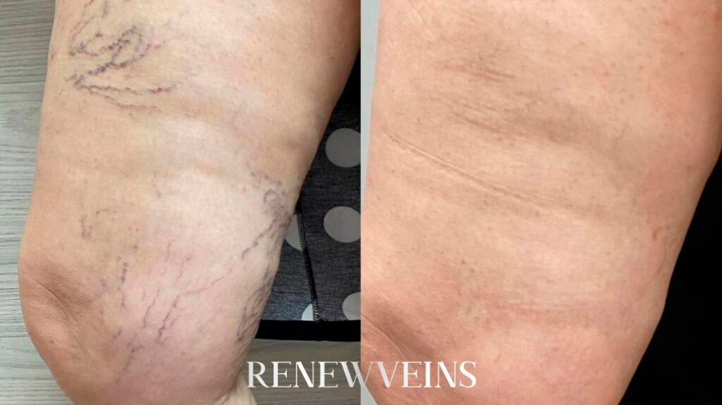 dep1_edit_renewveins