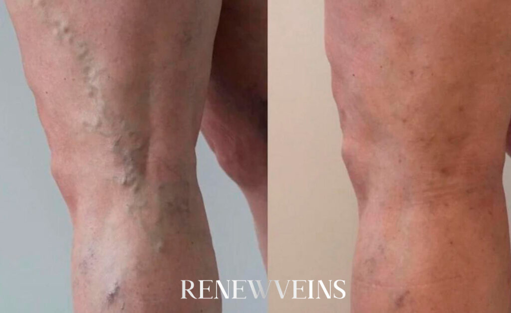 dep4_edit_renewveins