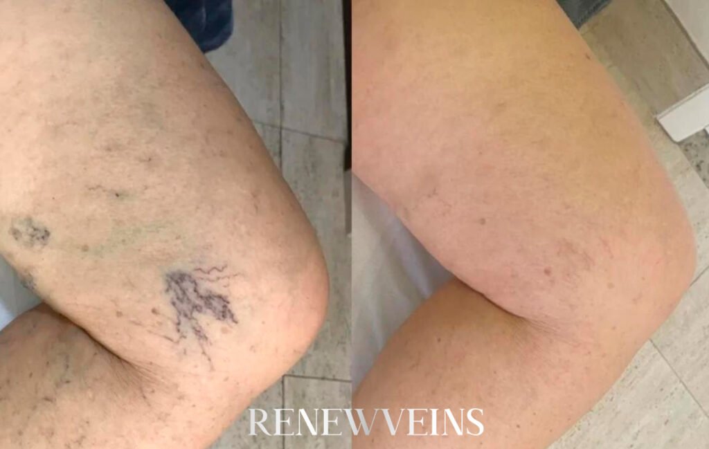 dep2_edit_renewveins-1024x649-1.jpg